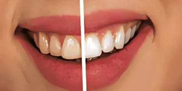 خلطة تجميلية لتبيض الأسنان