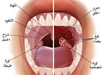 علاج التهاب اللوزتين بدون جراحة