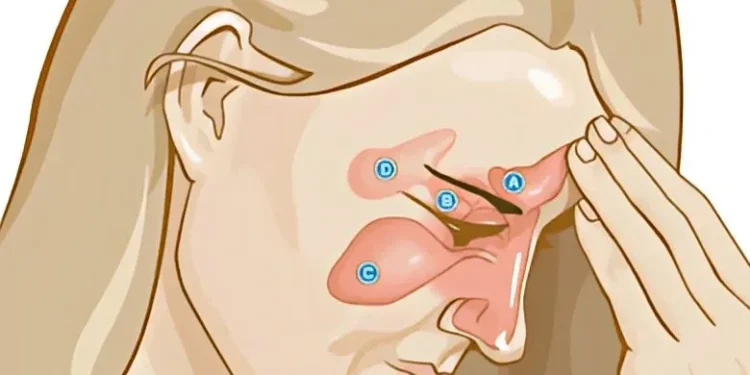 أسباب انسداد الأنف (الجيوب الأنفية)