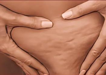 تخلصي من السيلولايت بهذه الخطوات
